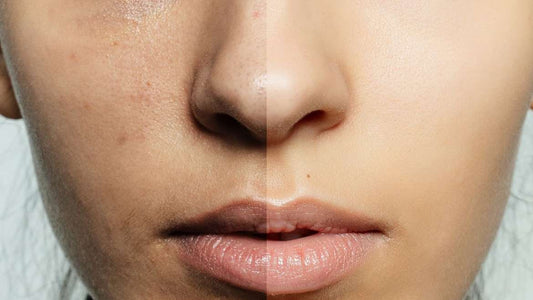 Salicylic Acid Vs Glycolic Acid What’s The Good Product For You