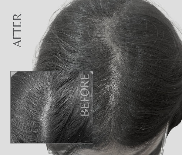 EnagenBio Degrease Pro Anti-Dandruff Scalp Serum