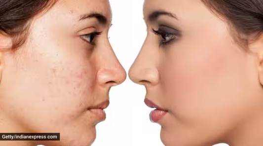 Skincare alert: Three good habits that can ‘help clear acne’