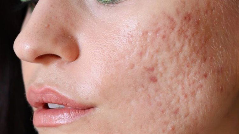 How to Treat Acne Scars for Clearer Blemish Free Skin