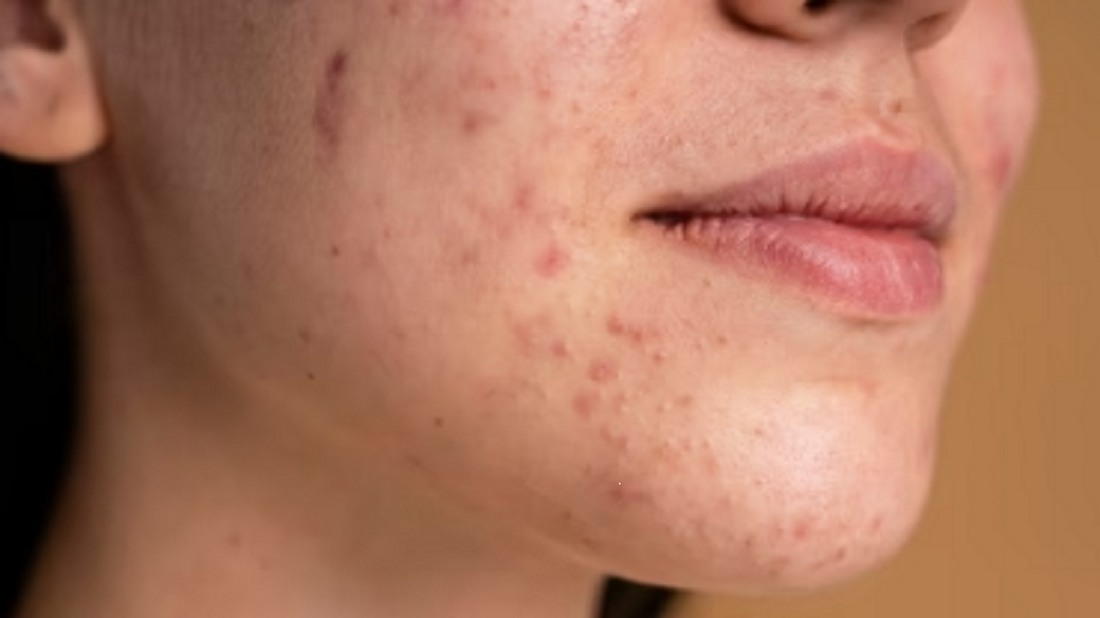 All You Need to Know About Melasma