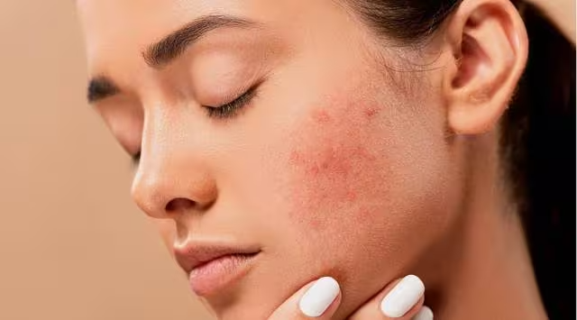 Acne and rosacea: A dermatologist explains the difference