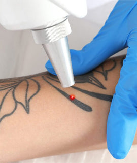 Lasers For Tattoo Removal - Sarinskin