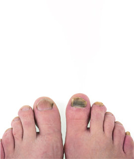 Ingrown Toe Nails - Sarinskin