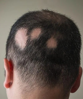 Alopecia Areata - Sarinskin