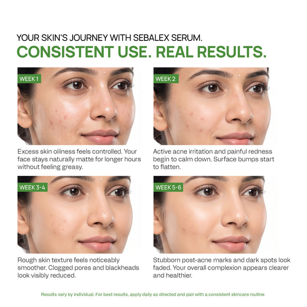 Yuderma Sebalex Acne Creamish Gel